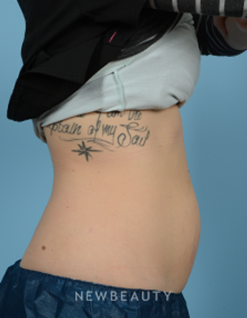 Dr. Jeffrey Wise - CoolSculpting - Before