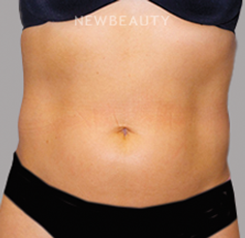Dr. Sanjay Grover - Liposuction - 49728009 - Before