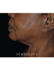 Dr. Lee Ann Klausner Ulthera Skin Tightener - After