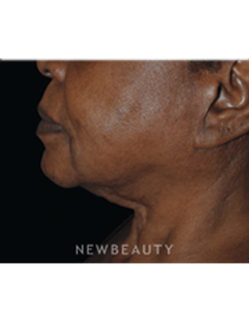 Dr. Lee Ann Klausner Ulthera Skin Tightener - After