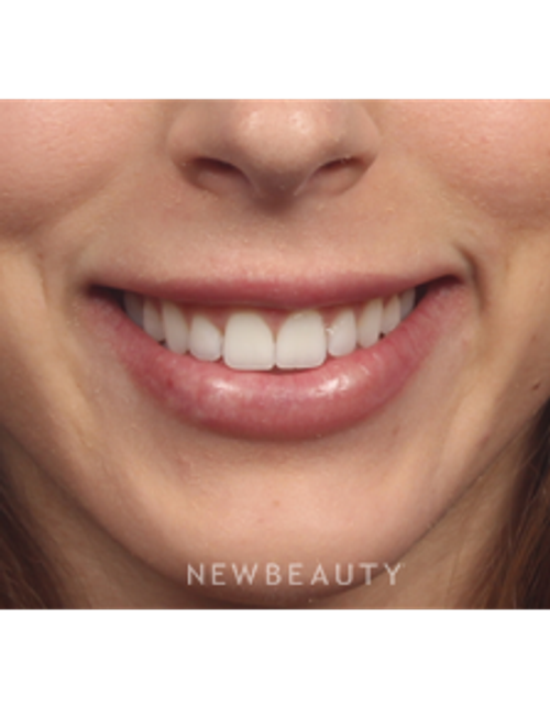Dr. Kelly Bomer - Botox - After