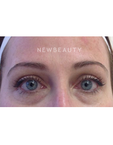 Dr. Julie Russak - Injectables & Fillers - Before