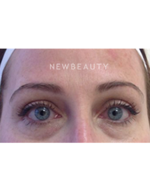 Dr. Julie Russak - Injectables & Fillers - Before
