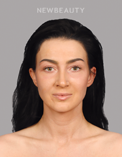 Dr. Raman Mahabir - Lower Eyelid - After