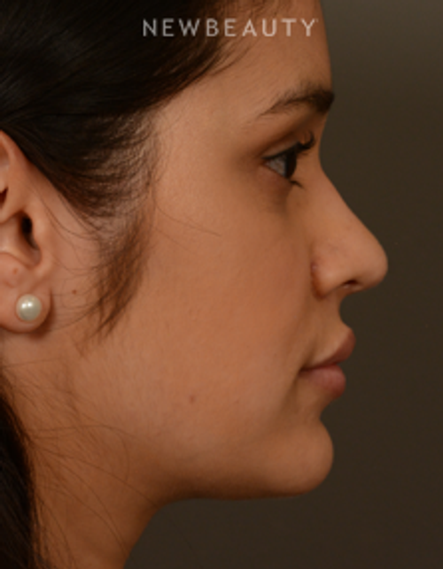 Dr. David Kim - Rhinoplasty - After
