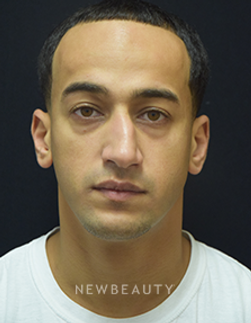 Dr. Jeffrey B. Wise - Rhinoplasty - Before