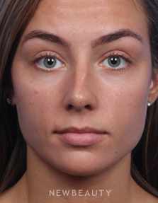 Dr. James Bouzoukis - Nonsurgical Rhinoplasty - Before