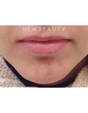 Dr. Julie Russack Injectables and Fillers - After