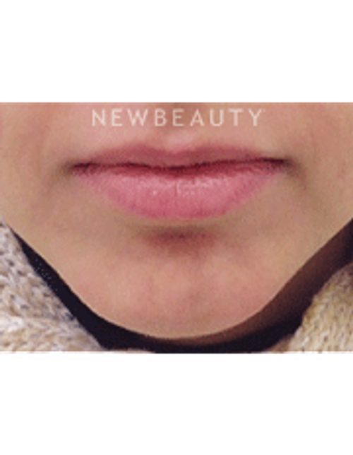 Dr. Julie Russack Injectables and Fillers - After