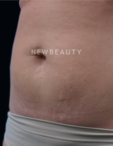 Dr. Ruth Hillelson Skin Resurfacing - After