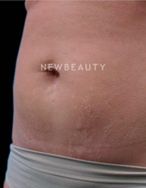 Dr. Ruth Hillelson Skin Resurfacing - After
