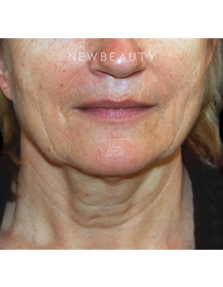 Dr. Roman Rayham - Rejuvenated Look - Before