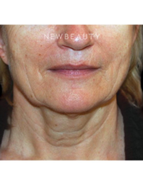 Dr. Roman Rayham - Rejuvenated Look - Before