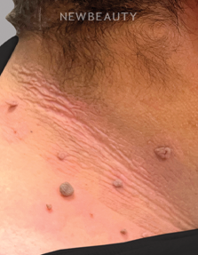 Dr. Anna Chacon - Skin Tags/Wart - 34279643 - Before