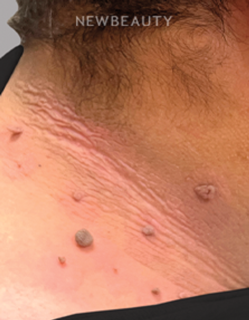 Dr. Anna Chacon - Skin Tags/Wart - 34279643 - Before