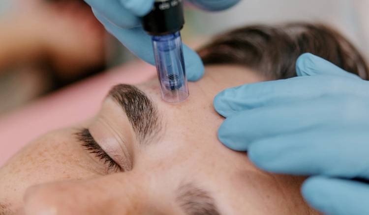 Close-up of a person receiving a microneedling treatment on the forehead from a practitioner wearing blue gloves.
