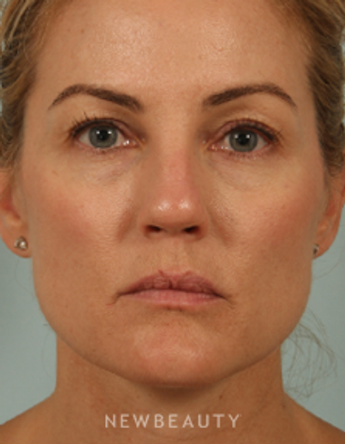 Dr. Kenneth Beer - Natural-Looking Rejuvenation - Before