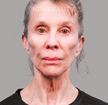 Dr. Michael Zwicklbauer - Youthful Restoration - 44689427 - Before