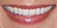 Dr. Nathan Hoffman - Smile Makeover - Before