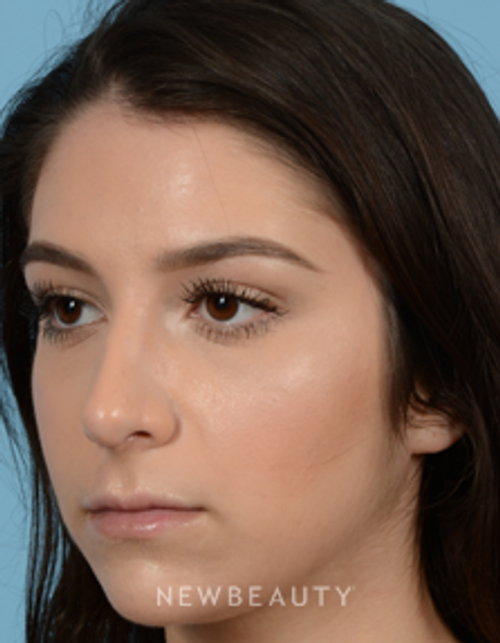 Dr. Jeffrey B. Wise - Rhinoplasty - After