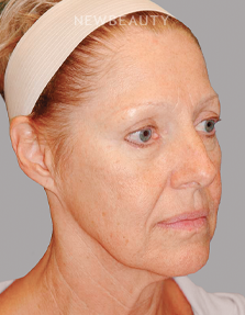 Dr. E. Gaylon McCollough - Refreshed and Renewed - 44692654 - Before