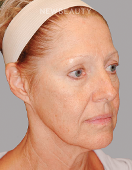 Dr. E. Gaylon McCollough - Refreshed and Renewed - 44692654 - Before