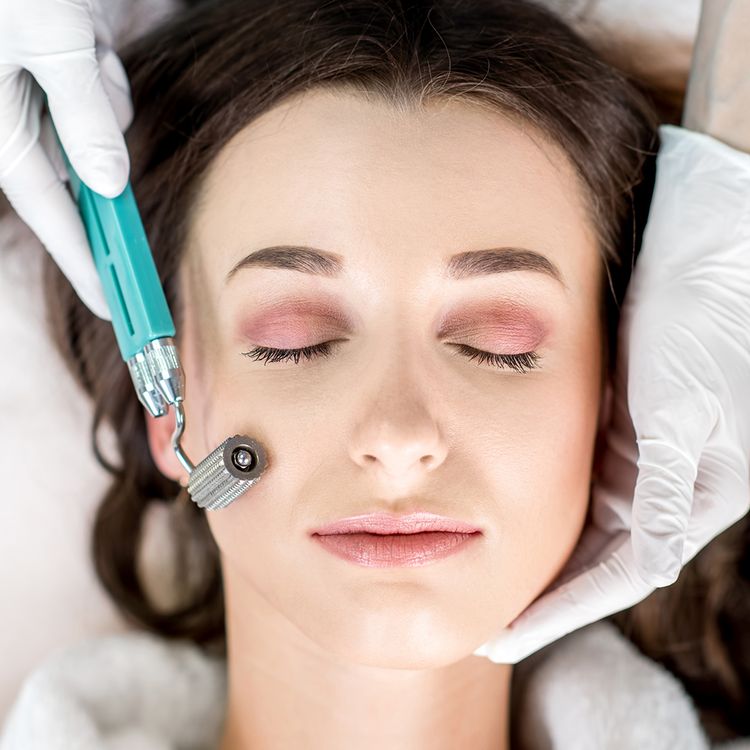 microneedling