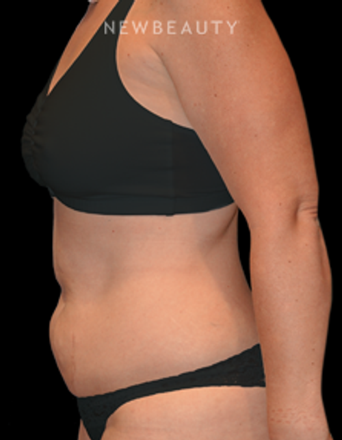 Dr. Bryan W. Gawley - A Slender Shape - Before