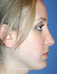 Dr. Kelly Bomer, Chin Augmentation, Rhinoplasty - After