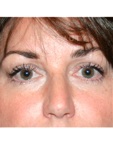 Dr. Kelly Bomer Liquid Facelift - After