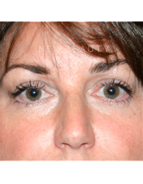 Dr. Kelly Bomer Liquid Facelift - After