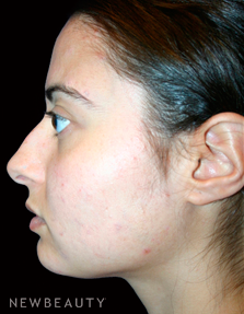 Dr. Kelly Bomer Rhinoplasty - Before