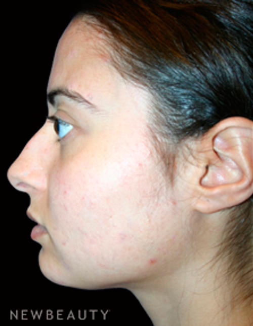 Dr. Kelly Bomer Rhinoplasty - Before