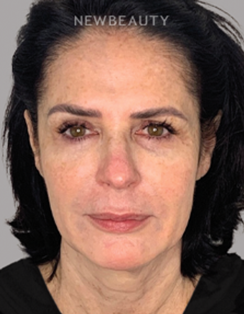 Dr. Dilip Madnani - Facelift -  45284120 - Before