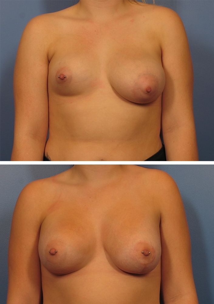 Breast Augmentation Surgery for Breast Asymmetry