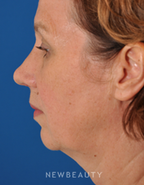 Dr. Edward Kwak - Rhinoplasty - After