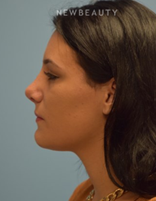 Dr. Jeffrey B. Wise- Rhinoplasty - After