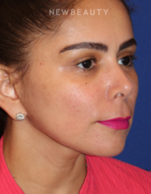 Dr. Dilip D. Madnani - Mini-Facelift - After