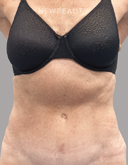 Dr. Christine Hamori – Tummy Tuck – 52892827 - After