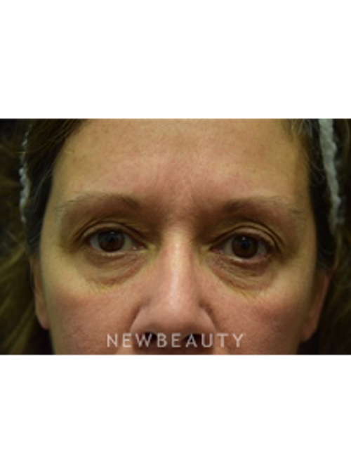 Dr. Jeffrey B. Wise - Blepharoplasty - Before