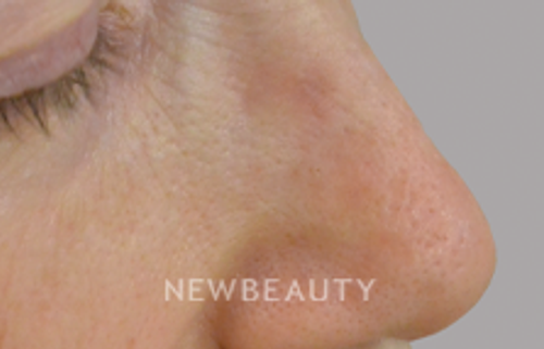 Dr. Anthony Bared - Profile Harmony - 44695544 - After