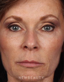 Dr. Kelly Bomer - Fillers - After