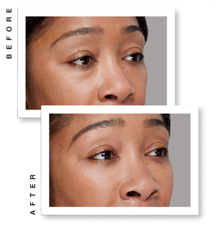 Restylane Eyelight Restylane Eyelight