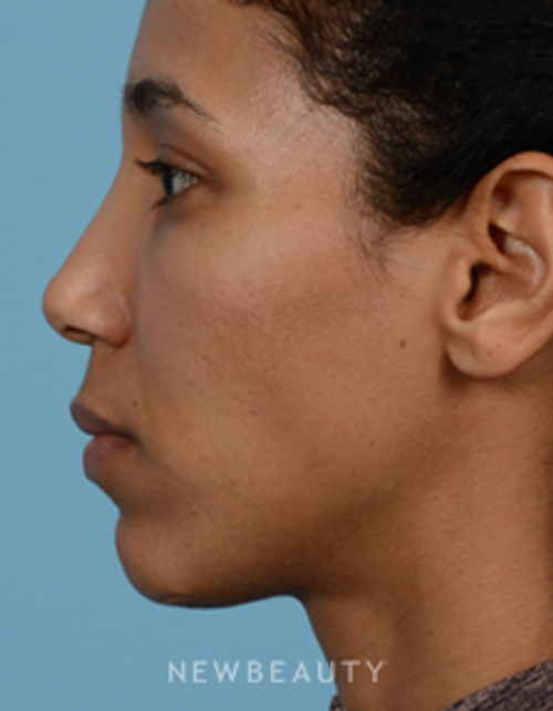Dr. Jeffrey B. Wise - Nasal Tip Refinement - Before