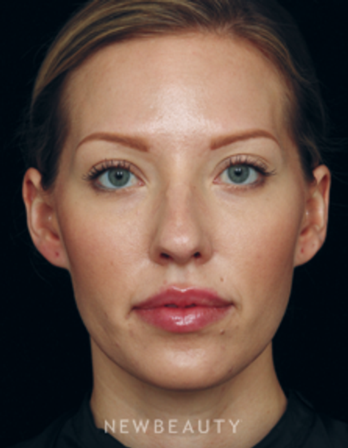 Dr. Jennifer Segal Browlift, Cheek Augmentation, Lip Enhancement, Non-surgical Rhinoplasty - After