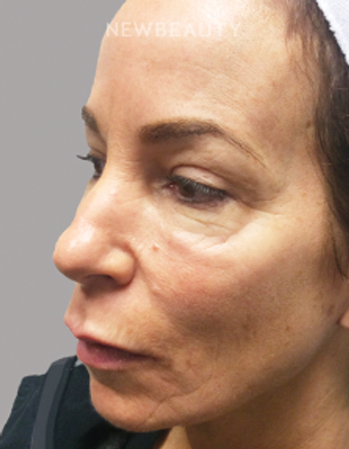 Dr. Linda Honet - Injectables & Fillers - 15045893 - Before