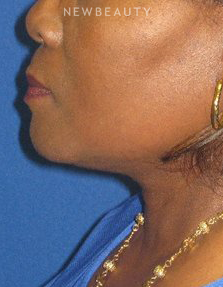 Dr. Dilip D. Madnani – Facelift - After