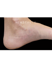 Dr. Jody Levine - Sclerotherapy - After