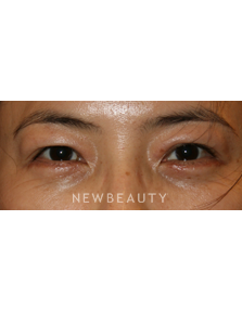 Dr. John Kang - Lower Blepharoplasty - After