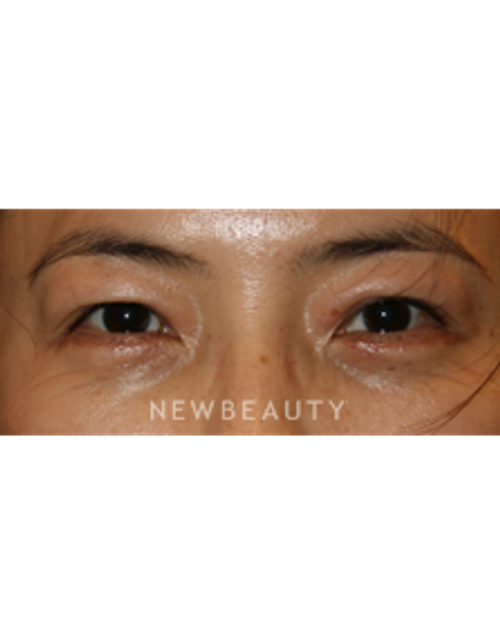 Dr. John Kang - Lower Blepharoplasty - After